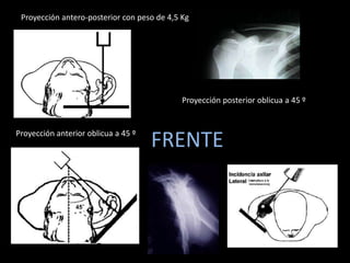 Suspensión de escápula