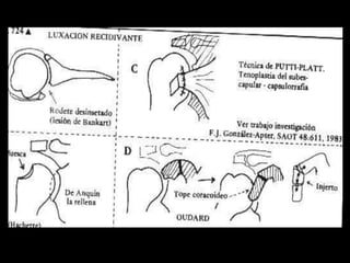 CONTRACTURA(DELTOIDES,TRAPECIO,ESCALENO)