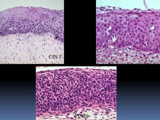 Cervical intra epithelial neoplasia | PDF
