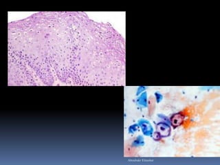 Cervical intra epithelial neoplasia | PDF