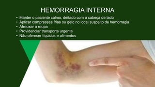 HEMORRAGIA INTERNA
• Manter o paciente calmo, deitado com a cabeça de lado
• Aplicar compressas frias ou gelo no local suspeito de hemorragia
• Afrouxar a roupa
• Providenciar transporte urgente
• Não oferecer líquidos e alimentos
 