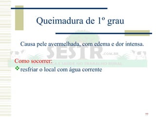 77
Queimadura de 1º grau
Causa pele avermelhada, com edema e dor intensa.
Como socorrer:
resfriar o local com água corrente
 