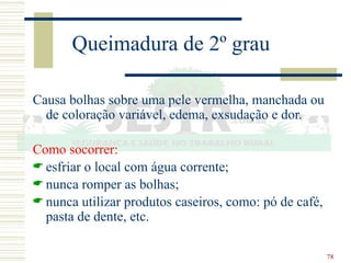 78
Queimadura de 2º grau
Causa bolhas sobre uma pele vermelha, manchada ou
de coloração variável, edema, exsudação e dor.
Como socorrer:
 esfriar o local com água corrente;
 nunca romper as bolhas;
 nunca utilizar produtos caseiros, como: pó de café,
pasta de dente, etc.
 