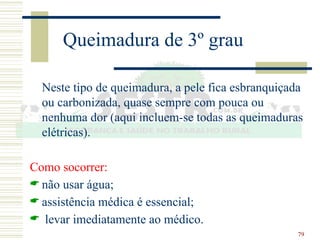 79
Queimadura de 3º grau
Neste tipo de queimadura, a pele fica esbranquiçada
ou carbonizada, quase sempre com pouca ou
nenhuma dor (aqui incluem-se todas as queimaduras
elétricas).
Como socorrer:
 não usar água;
 assistência médica é essencial;
 levar imediatamente ao médico.
 