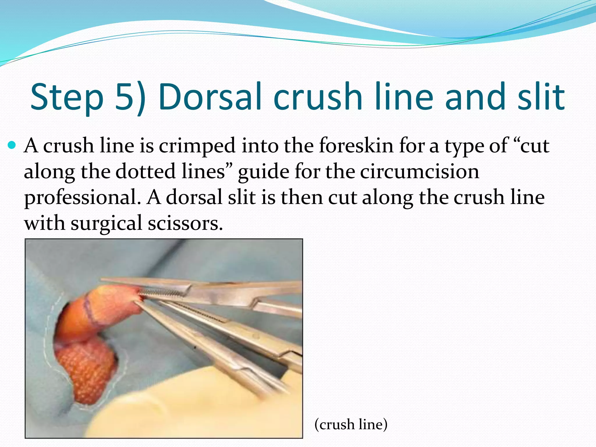 Step 5) Dorsal crush line and slit 
 A crush line is crimped into the foreskin for a type of “cut 
along the dotted lines” guide for the circumcision 
professional. A dorsal slit is then cut along the crush line 
with surgical scissors. 
(crush line) 
 