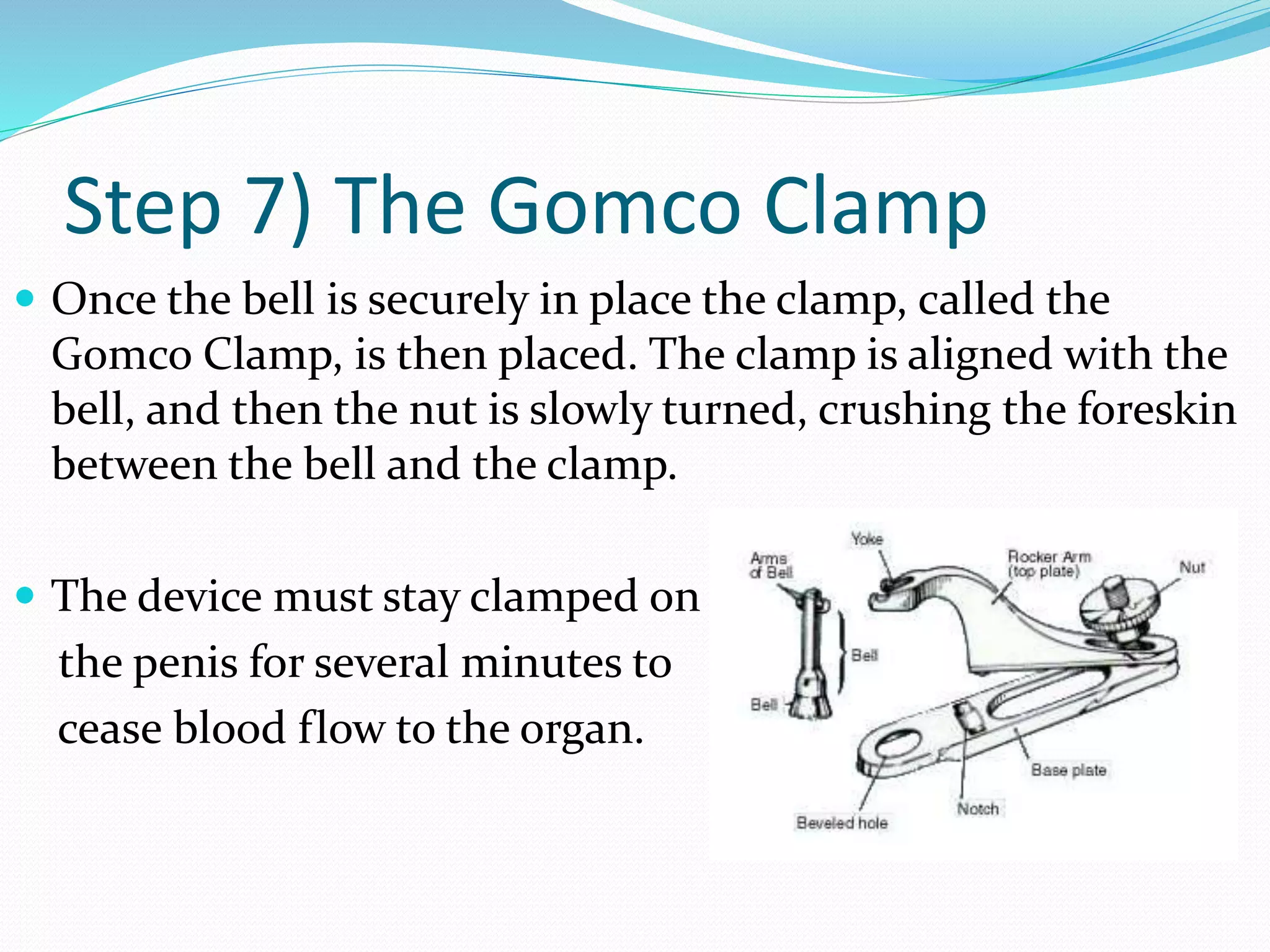 Step 7) The Gomco Clamp 
 Once the bell is securely in place the clamp, called the 
Gomco Clamp, is then placed. The clamp is aligned with the 
bell, and then the nut is slowly turned, crushing the foreskin 
between the bell and the clamp. 
 The device must stay clamped on 
the penis for several minutes to 
cease blood flow to the organ. 
 