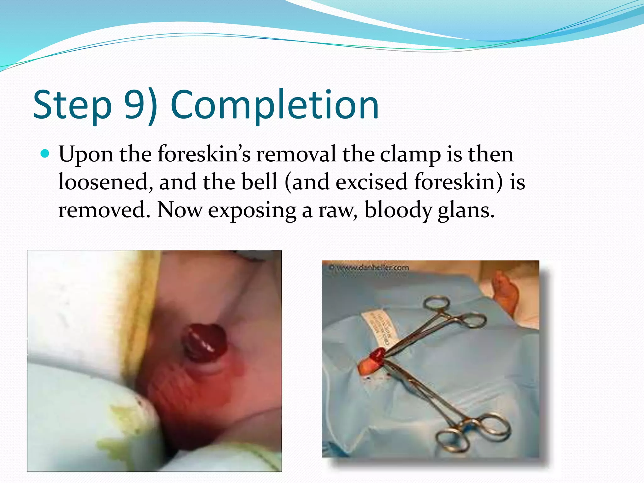 Step 9) Completion 
 Upon the foreskin’s removal the clamp is then 
loosened, and the bell (and excised foreskin) is 
removed. Now exposing a raw, bloody glans. 
 