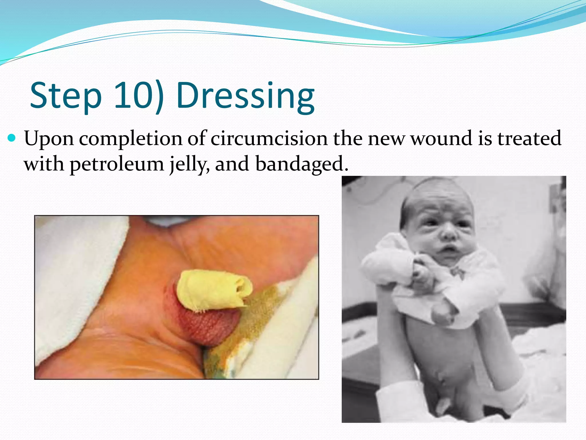 Step 10) Dressing 
 Upon completion of circumcision the new wound is treated 
with petroleum jelly, and bandaged. 
 
