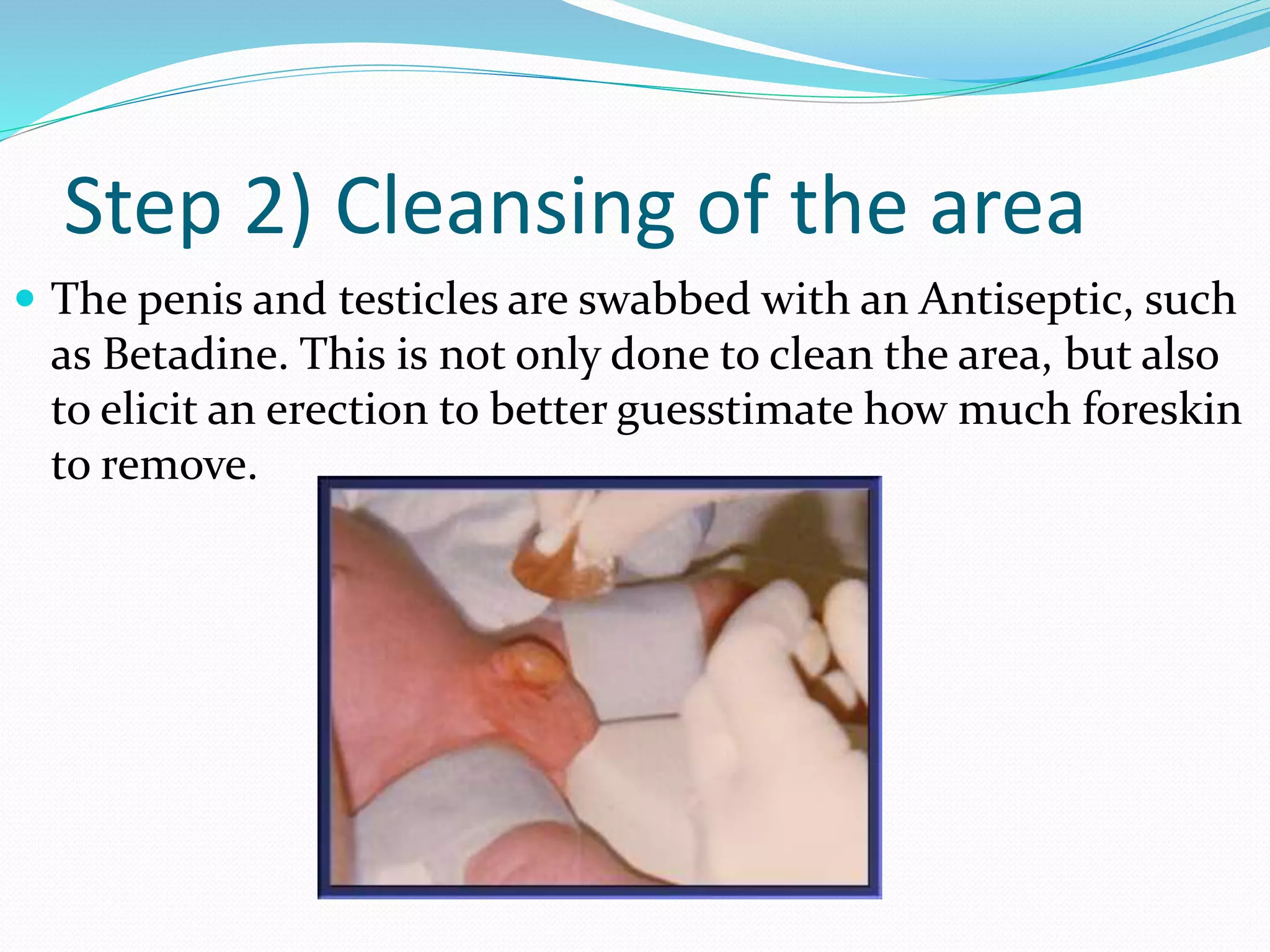 Step 2) Cleansing of the area 
 The penis and testicles are swabbed with an Antiseptic, such 
as Betadine. This is not only done to clean the area, but also 
to elicit an erection to better guesstimate how much foreskin 
to remove. 
 