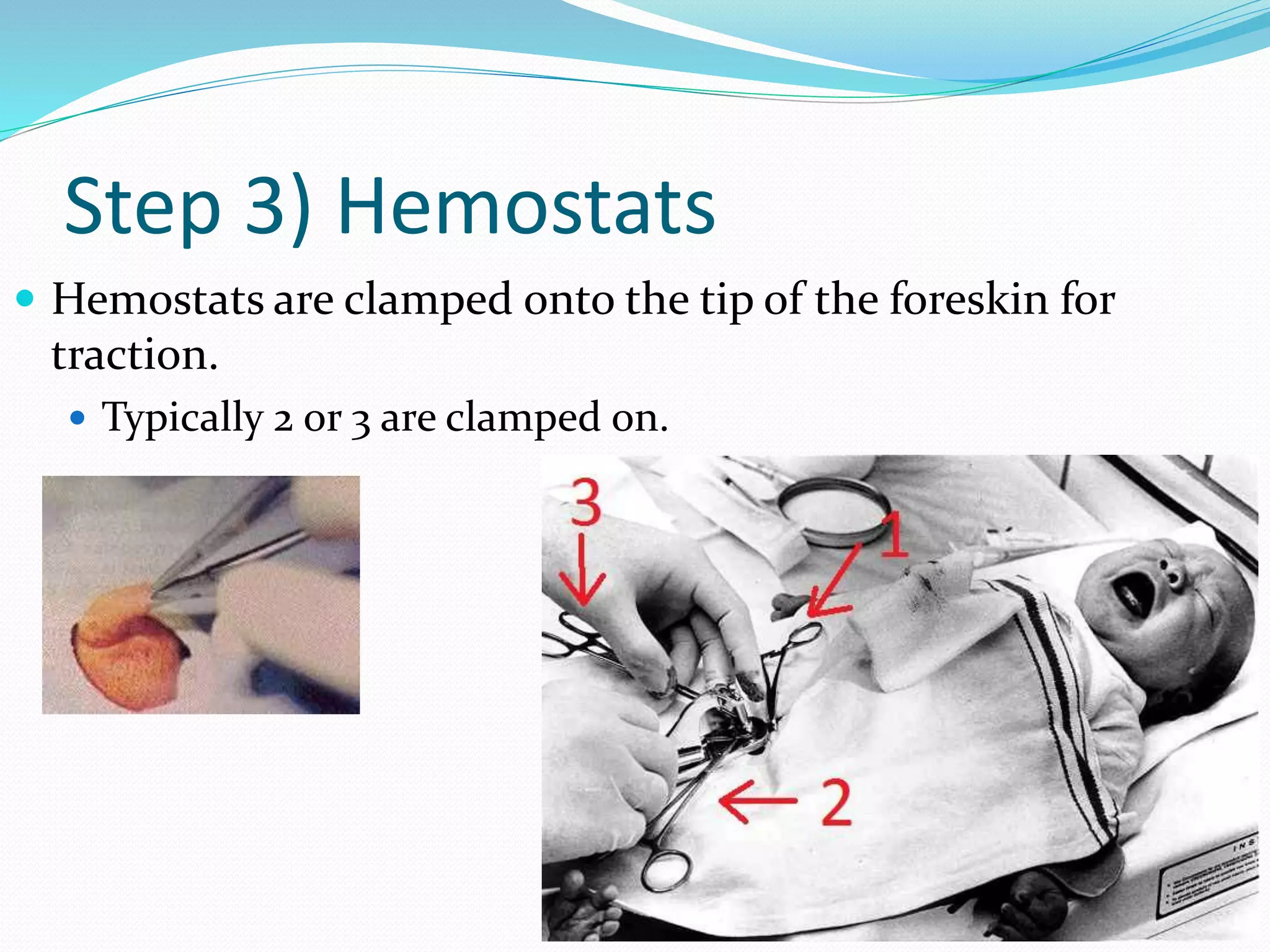 Step 3) Hemostats 
 Hemostats are clamped onto the tip of the foreskin for 
traction. 
 Typically 2 or 3 are clamped on. 
 