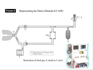 Relocation of fresh gas, F, distal to I valve.
FIGURE 4 Representing the Datex-Ohmeda S/5 ADU
 