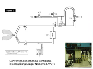 Conventional mechanical ventilation.
(Representing Dräger Narkomed AV2+)
 