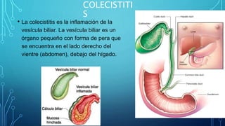 COLECISTITI
S
• La colecistitis es la inflamación de la
vesícula biliar. La vesícula biliar es un
órgano pequeño con forma de pera que
se encuentra en el lado derecho del
vientre (abdomen), debajo del hígado.
 