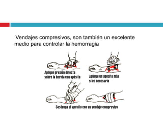 Vendajes compresivos, son también un excelente
medio para controlar la hemorragia
 