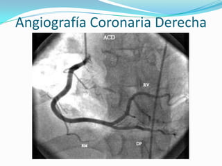 Angiografía Coronaria Derecha