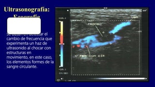 Ultrasonografía:
Ecografía
Doppler
Se basan en detectar el
cambio de frecuencia que
experimenta un haz de
ultrasonido al chocar con
estructuras en
movimiento, en este caso,
los elementos formes de la
sangre circulante.
 