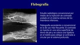 Flebografia
Estudio radiológico convencional por
medio de la inyección de contraste
yodado en el sistema venoso de los
miembros inferiores.
Flebografía ascendente o convencional:
es la de uso más frecuente. El contraste
se inyecta en una vena superficial de
dorso de pie y se coloca una ligadura
en el tobillo para obligar al contraste a
circular por el sistema profundo.
 