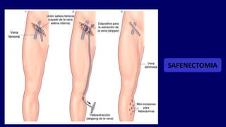 SAFENECTOMIA
 