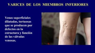 VARICES DE LOS MIEMBROS INFERIORES
Venas superficiales
dilatadas, tortuosas
que se producen por
defectos en la
estructura y función
de las válvulas
venosas.
 