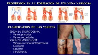 PROGRESION EN LA FORMACION DE UNA VENA VARICOSA
CLASIFICACIÓN DE LAS VARICES
SEGÚN SU ETIOPATOGENIA:
• Varices primarias
• Varices secundarias
SEGÚN SU MORFOLOGÍA
• Varículas o varices intradermicas
• Cilíndricas
• Saculares
• Serpiginosas
 
