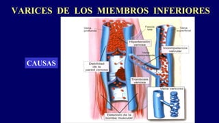 VARICES DE LOS MIEMBROS INFERIORES
CAUSAS
 
