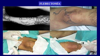 FLEBECTOMÍA
 