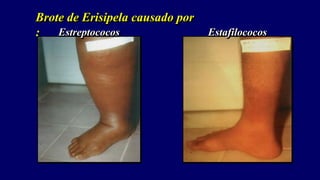 Brote de Erisipela causado por
: Estafilococos
Estreptococos
 