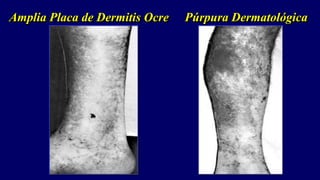 Amplia Placa de Dermitis Ocre Púrpura Dermatológica
 