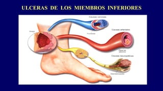 ULCERAS DE LOS MIEMBROS INFERIORES
 