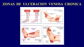 ZONAS DE ULCERACION VENOSA CRONICA
 