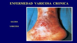 ENFERMEDAD VARICOSA CRONICA
ULCERA
VARICOSA
 