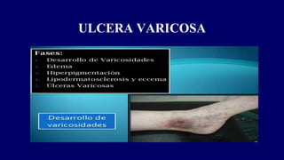 ULCERA VARICOSA
 