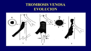 TROMBOSIS VENOSA
EVOLUCION
 