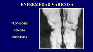 ENFERMEDAD VARICOSA
TROMBOSIS
VENOSA
PROFUNDA
 