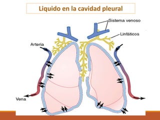 Liquido en la cavidad pleural
 
