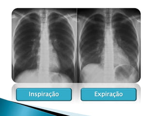 Inspiração Expiração
 