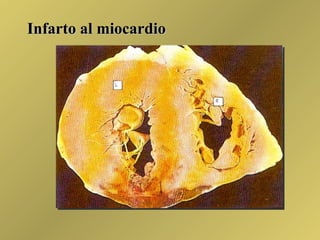 Infarto al miocardio 