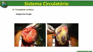 4) Transplante cardíaco
Imagens da cirurgia
Sistema Circulatório
 