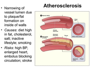 • Narrowing of
vessel lumen due
to plaque/fat
formation on
inside of walls
• Causes: diet high
in fat, cholesterol,
salt; inactive
lifestyle; smoking
• Risks: high BP,
enlarged heart,
embolus blocking
circulation; stroke
Atherosclerosis
 