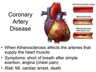 Coronary
Artery
Disease
• When Atherosclerosis affects the arteries that
supply the heart muscle
• Symptoms: short of breath after simple
exertion, angina (chest pain)
• Risk: MI, cardiac arrest, death
 