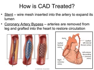 How is CAD Treated?
• Stent – wire mesh inserted into the artery to expand its
lumen
• Coronary Artery Bypass – arteries are removed from
leg and grafted into the heart to restore circulation
 
