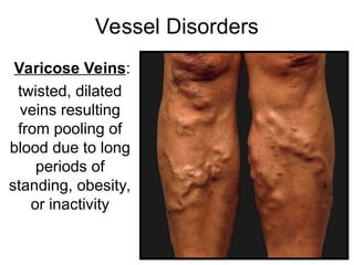 Vessel Disorders
Varicose Veins:
twisted, dilated
veins resulting
from pooling of
blood due to long
periods of
standing, obesity,
or inactivity
 