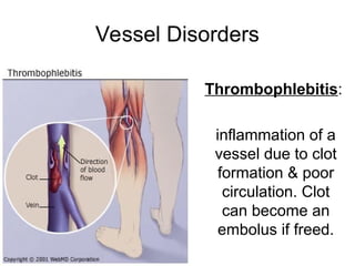 Vessel Disorders
Thrombophlebitis:
inflammation of a
vessel due to clot
formation & poor
circulation. Clot
can become an
embolus if freed.
 