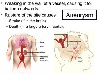 Aneurysm
• Weaking in the wall of a vessel, causing it to
balloon outwards.
• Rupture of the site causes
– Stroke (if in the brain)
– Death (in a large artery – aorta).
 