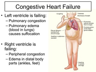 Congestive Heart Failure
• Left ventricle is failing:
– Pulmonary congestion
– Pulmonary edema
(blood in lungs)
causes suffocation
• Right ventricle is
failing:
– Peripheral congestion
– Edema in distal body
parts (ankles, feet)
 