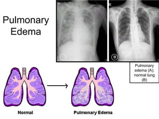 Pulmonary
Edema
Pulmonary
edema (A);
normal lung
(B)
 