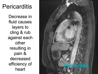 Pericarditis
Decrease in
fluid causes
layers to
cling & rub
against each
other
resulting in
pain &
decreased
efficiency of
heart
 