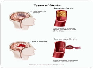 TYPES OF STROKE
 