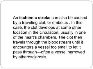 An ischemic stroke can also be caused
by a traveling clot, or embolus . In this
case, the clot develops at some other
location in the circulation, usually in one
of the heart’s chambers. The clot then
travels through the bloodstream until it
encounters a vessel too small to let it
pass through—often a vessel narrowed
by atherosclerosis.
 