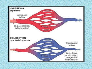 Circulatory disorders | PPTX